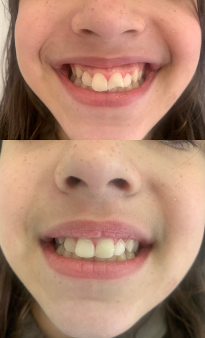Montagem comparativa de sorriso em duas fotografias