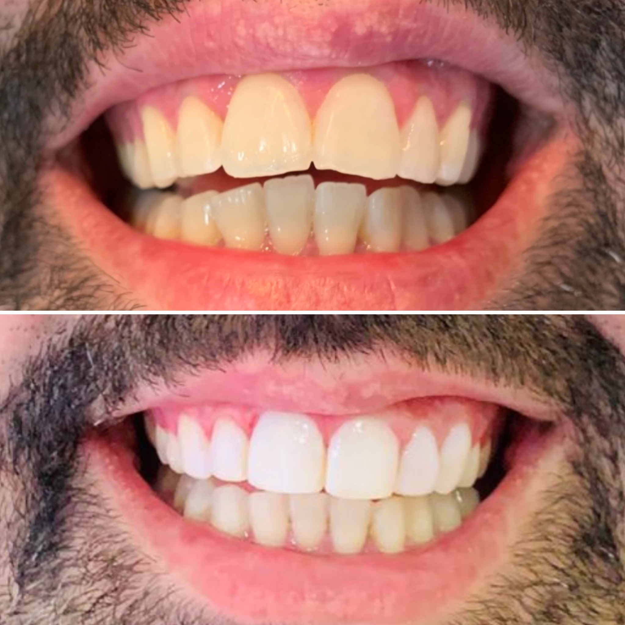 Duas fotografias comparativas dos dentes ao sorrir