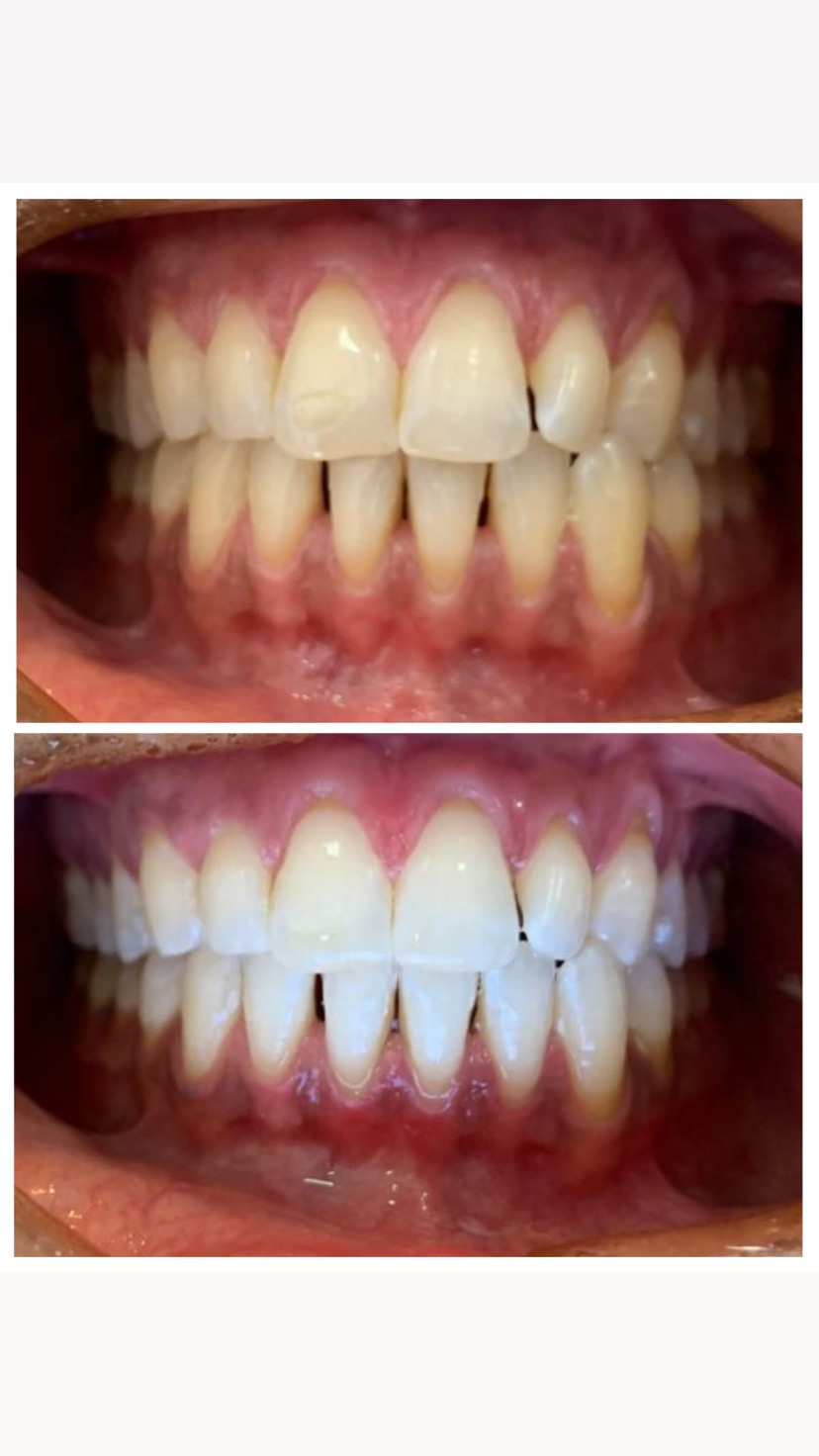 Comparativo dos dentes em duas fotografias