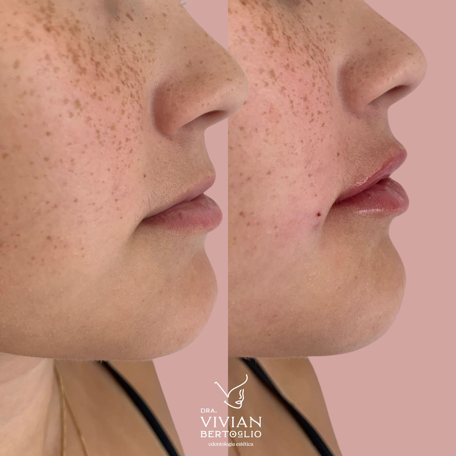 Duas fotografias comparativas do perfil facial
